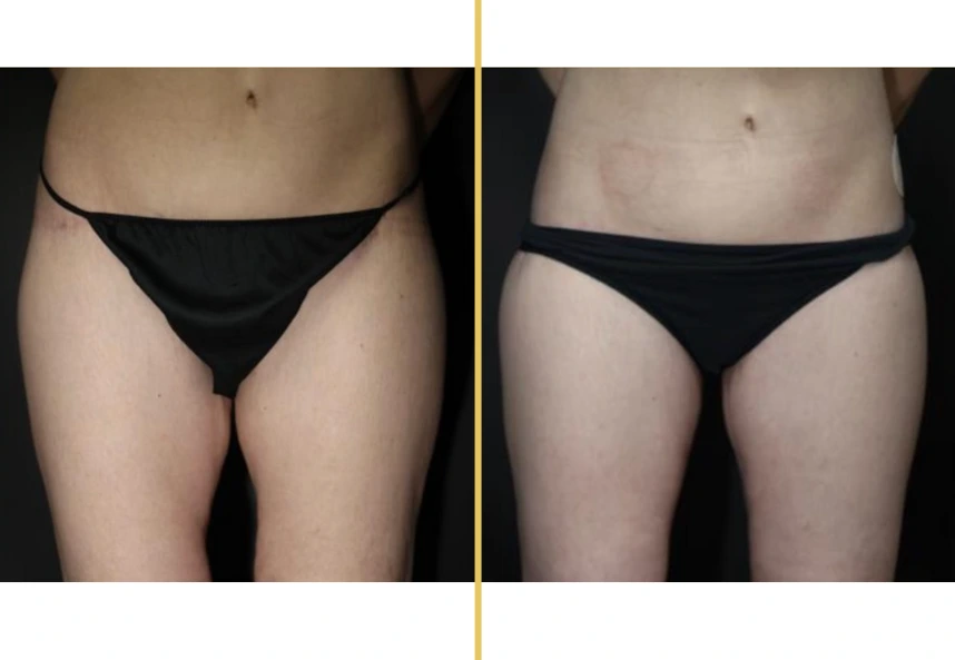 Before and after front view comparison of thigh contouring results
