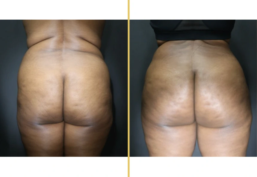 Before and after rear view comparison of buttock enhancement results