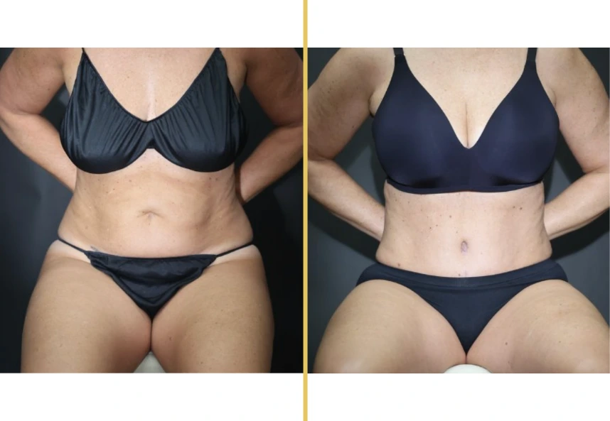 Before and after front views of torso showing body contouring results