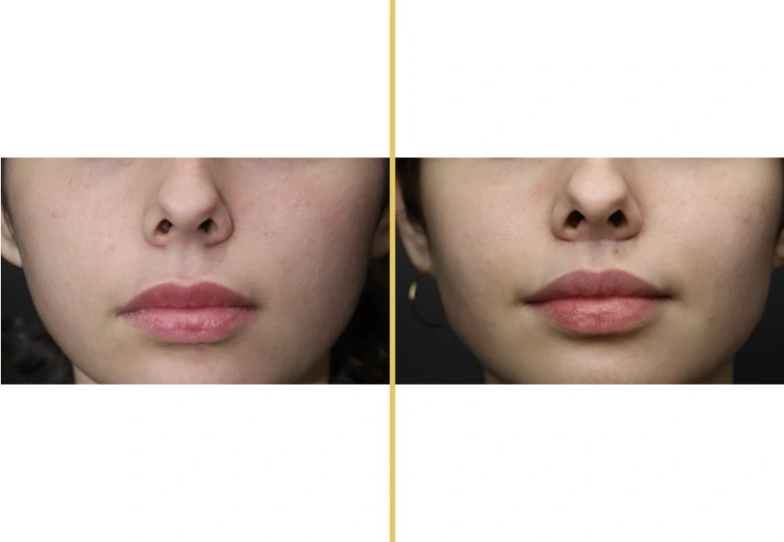 Before and after lip augmentation results in frontal view