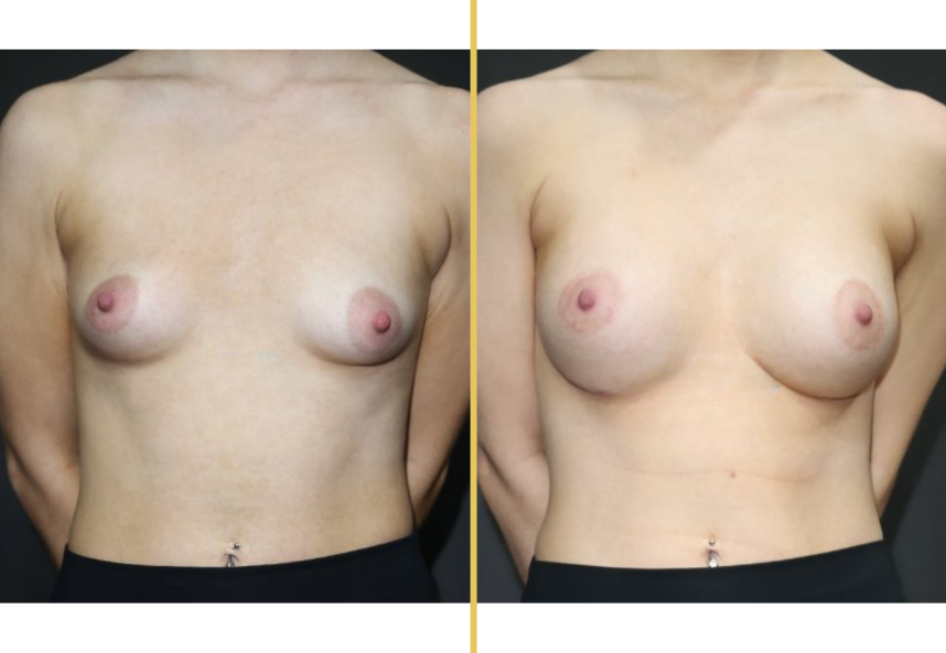 Before and after frontal view comparison of breast augmentation results