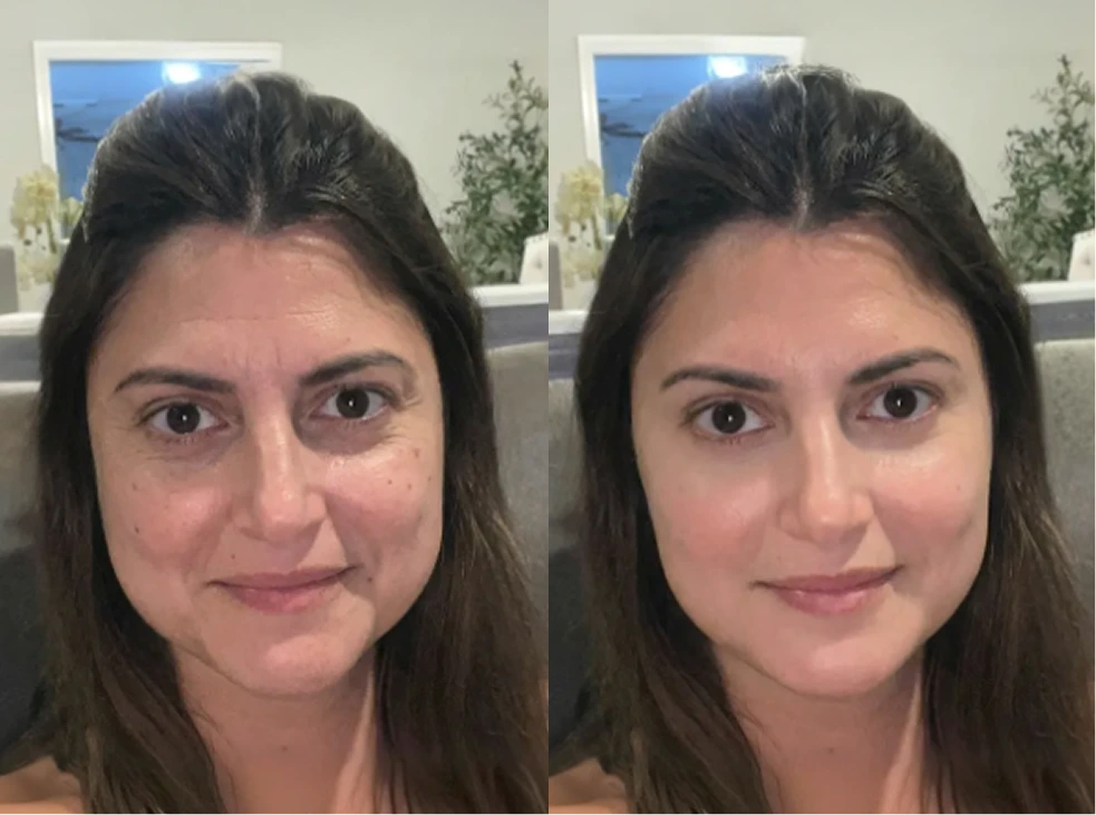 Before and after AI imaging comparison of woman's face showing skin smoothing results