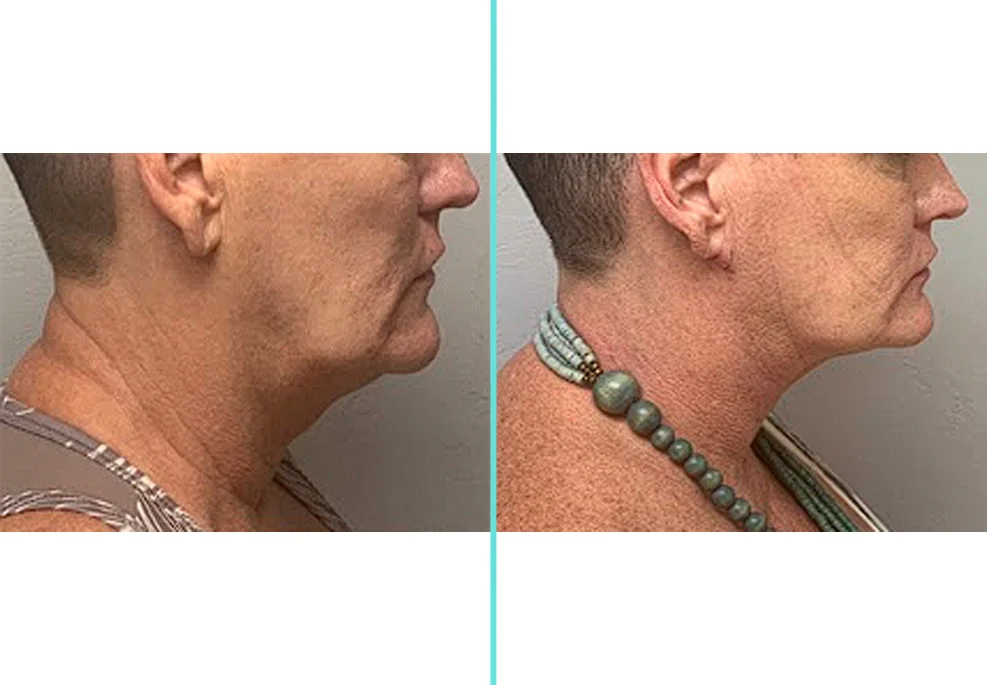 Before and after side profile comparison showing improved chin projection and neck definition