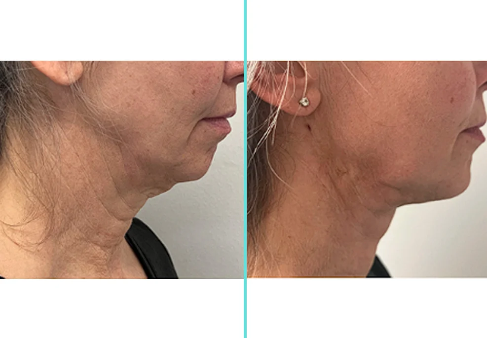 Before and after side profile comparison showing improved chin and neck contour