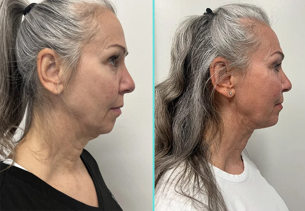 Before and after side profile comparison of a woman's face and neck showing improved contour