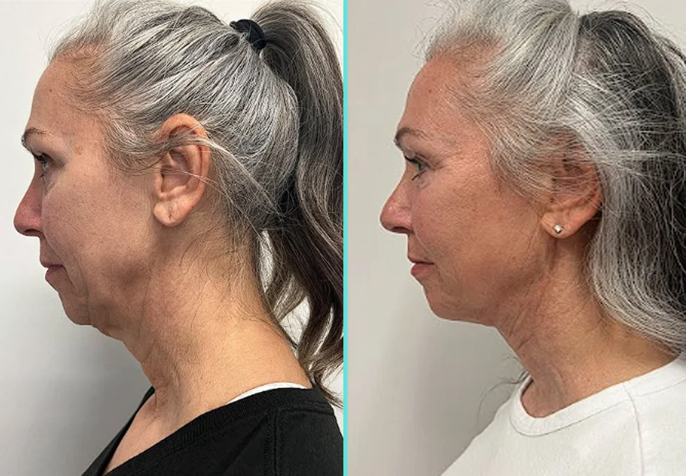 Before and after side profile comparison of a woman's neck and jawline showing enhanced definition