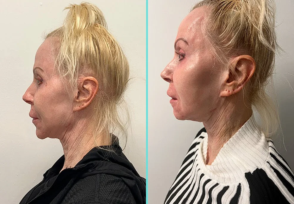 Before and after side profile showing improved neck laxity and jawline sharpness