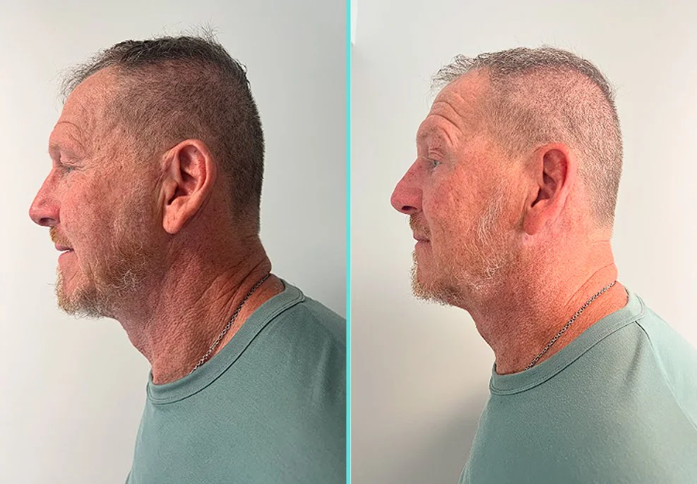Before and after side profile of male patient with improved facial contours and reduced jowling