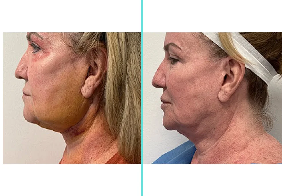 Before and after side profile demonstrating reduced neck sagging and improved facial definition