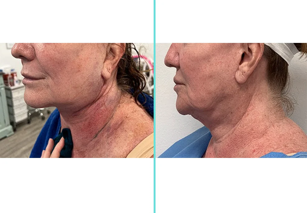 Before and after side profile comparison showing reduced neck laxity and improved jawline definition