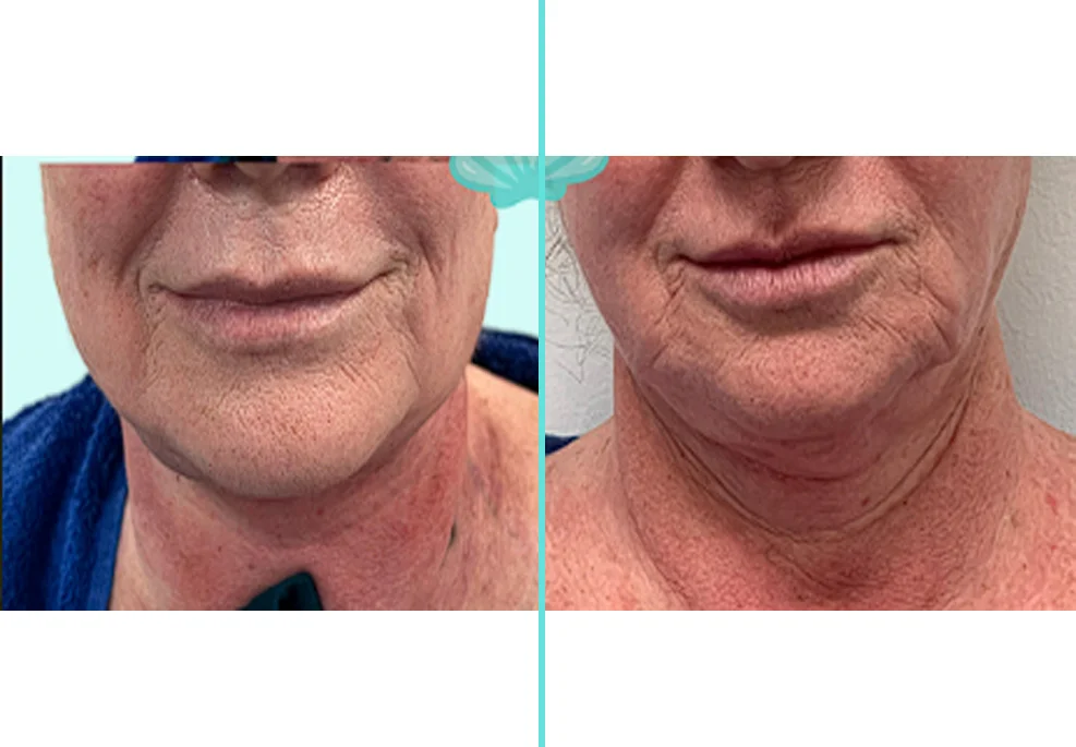 Before and after close-up of lower face showing improved skin texture and reduced jowls