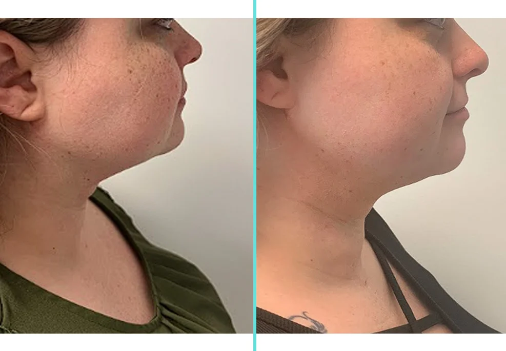 Before and after side profile comparison showing improved jawline and reduced submental fullness