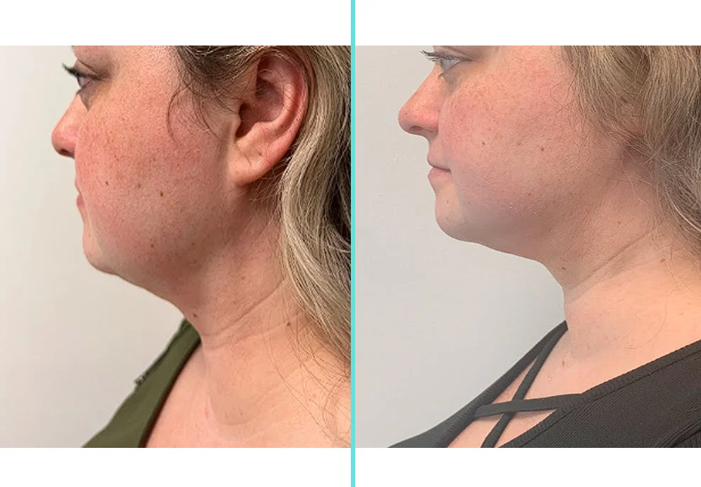 Before and after side profile comparison showing refined neck contour and improved definition
