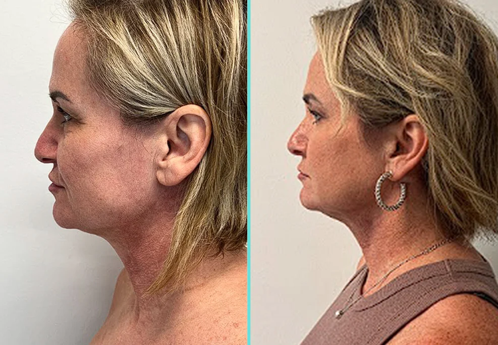 Before and after profile views of woman's chin and jawline showing improved definition