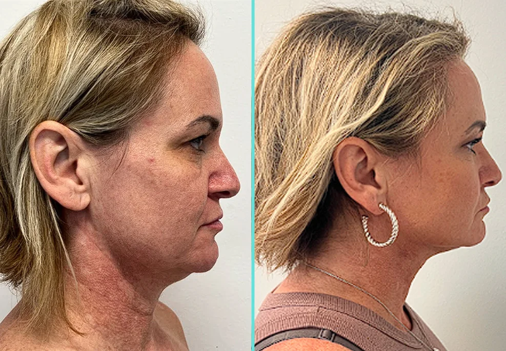 Before and after side profile views of woman's chin and neck showing enhanced contour