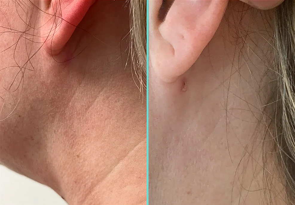 Before and after close-up of neck incision site showing minimal scarring
