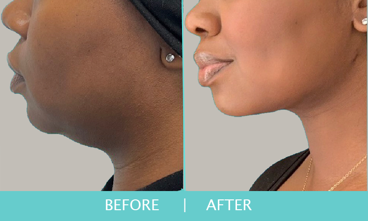 Jax-Body-Chin-Liposuction-1-2