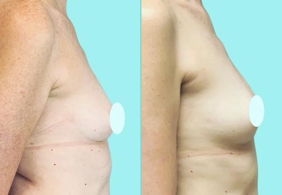 Side profile before and after breast fat transfer showing enhanced breast shape