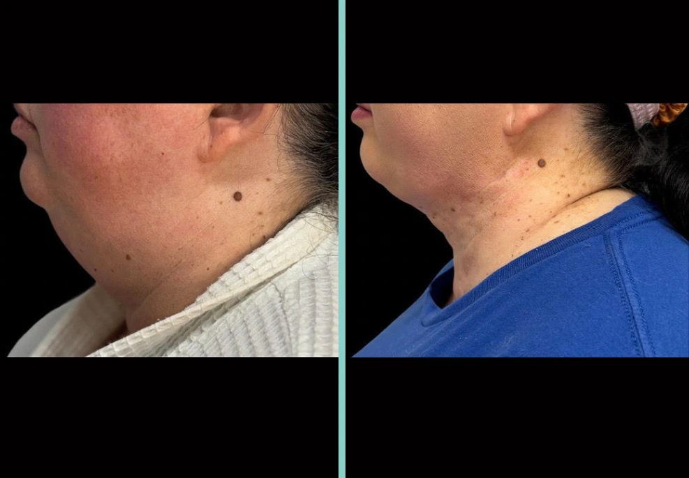 Before and after chin augmentation, side profile comparison