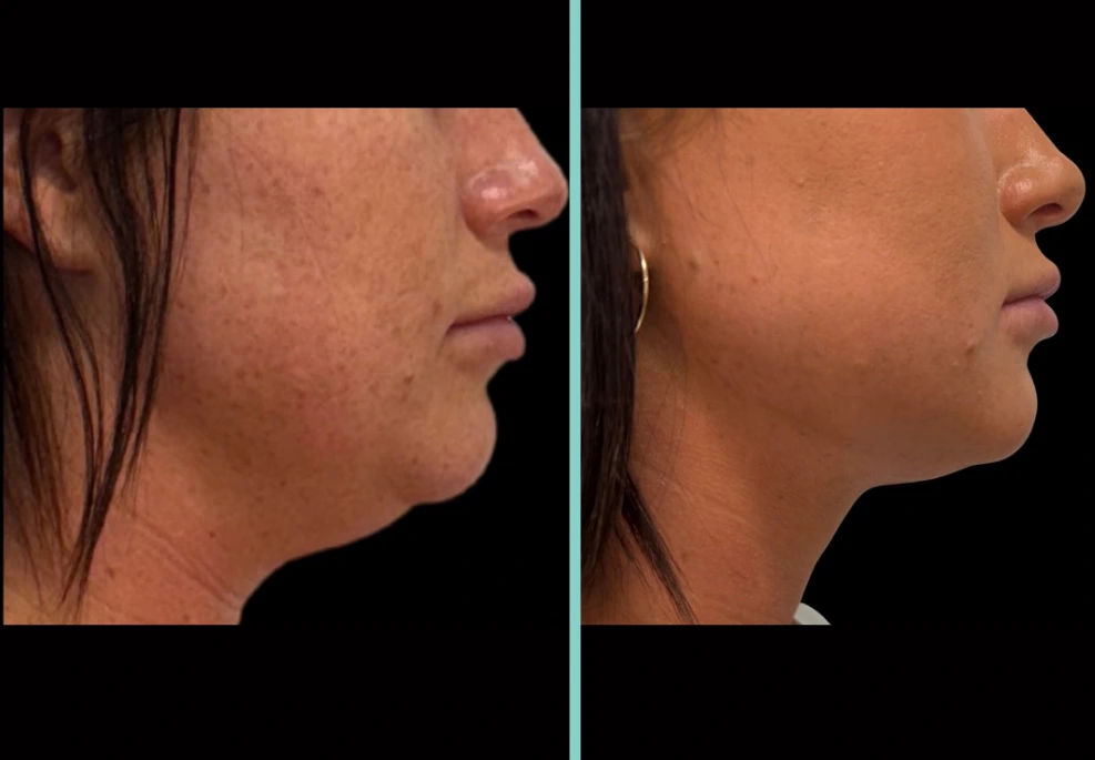 Before and after facial rejuvenation, side profile comparison