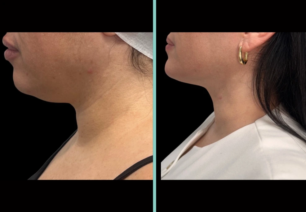 Before and after comparison of patient neck profile showing improved jawline definition