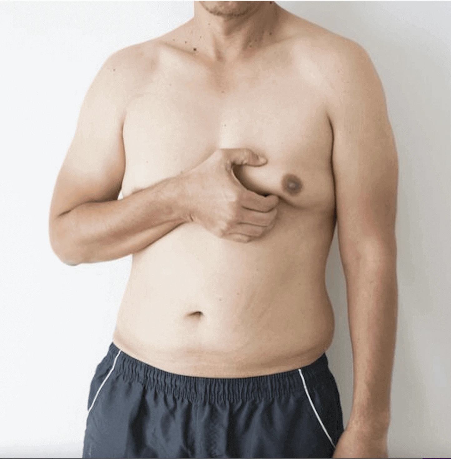 male with gynecomastia