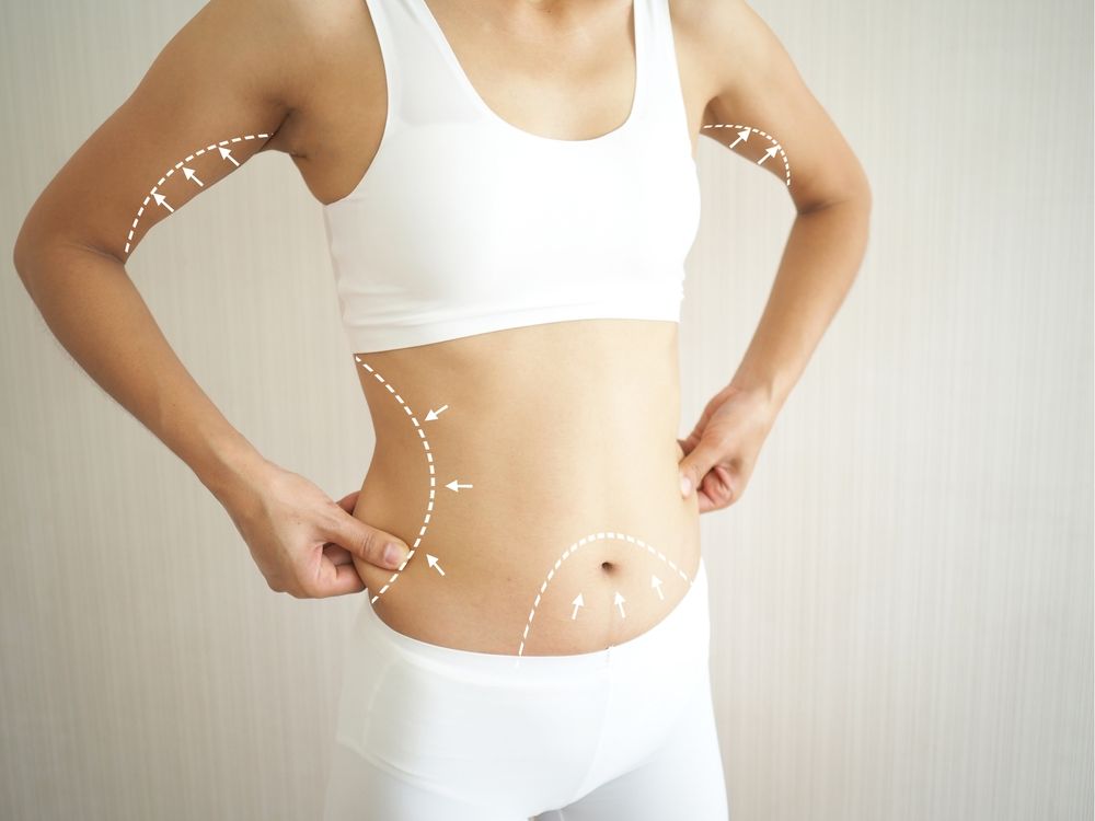 Liposuction and Dieting: A Winning Combination for a Slimmer You