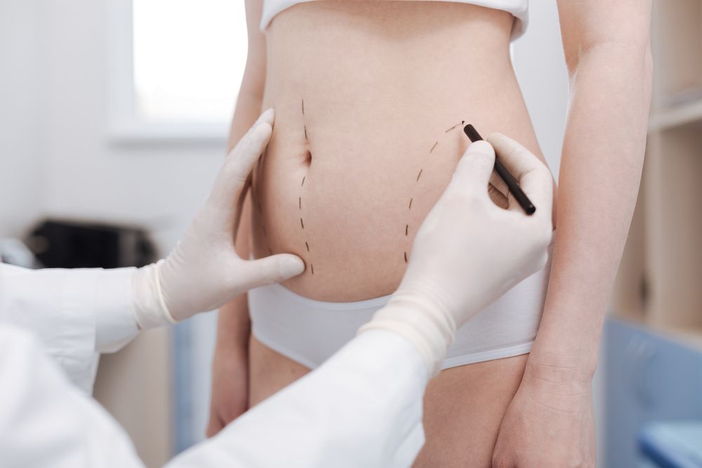 How to Prepare for a Liposuction Consultation