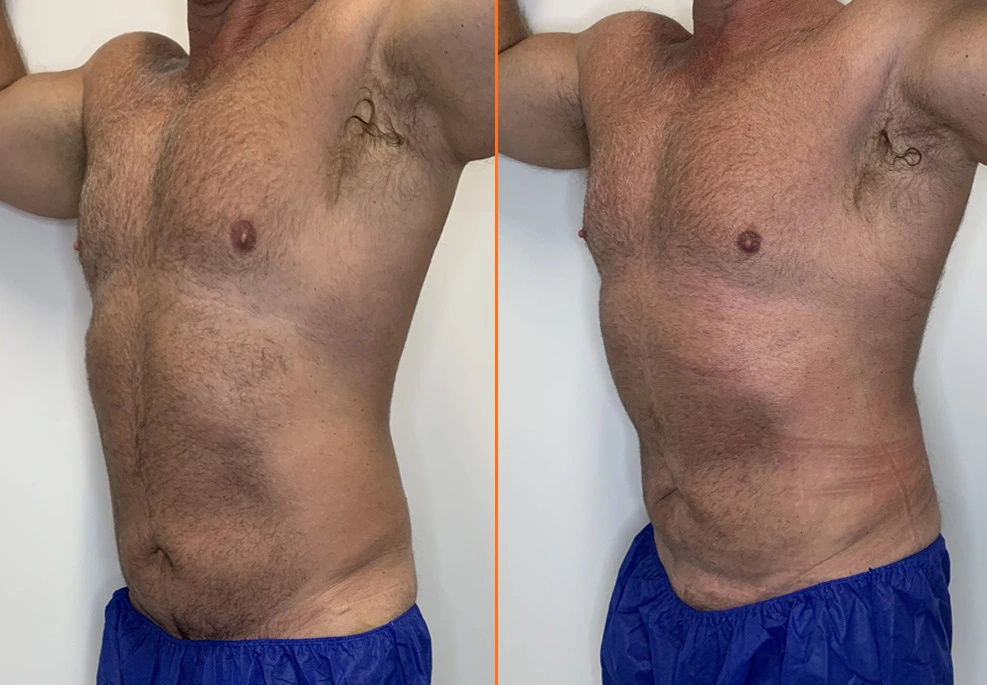 Lipo 360 Case -oblique male