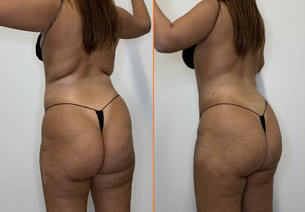 Lipo 360 Case-back female