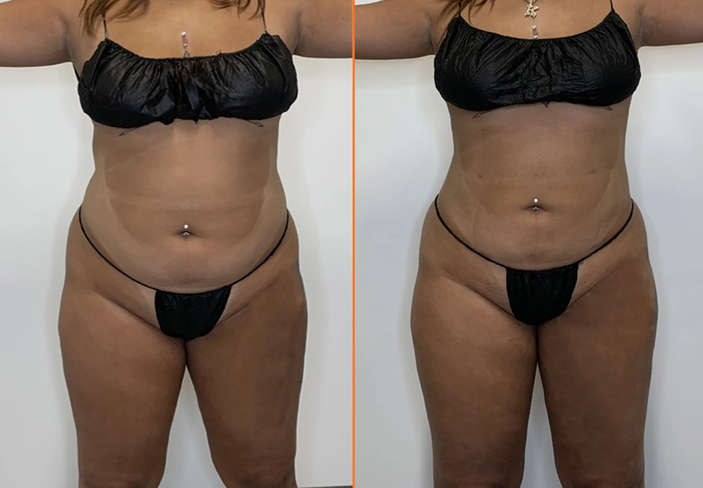 Lipo 360 Case-front female