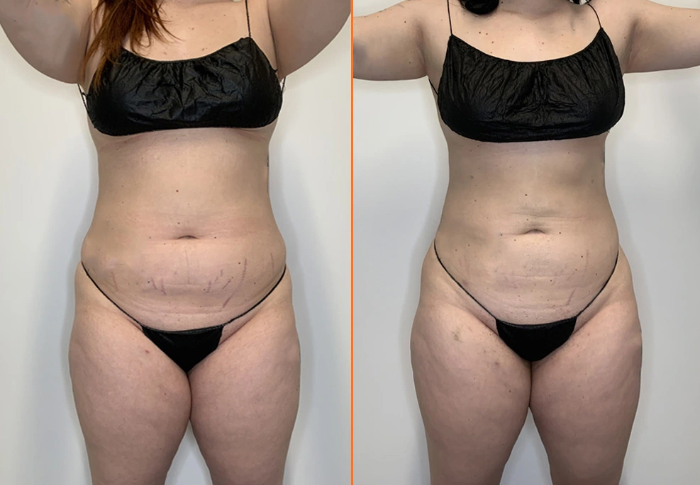 Lipo 360 Case Front