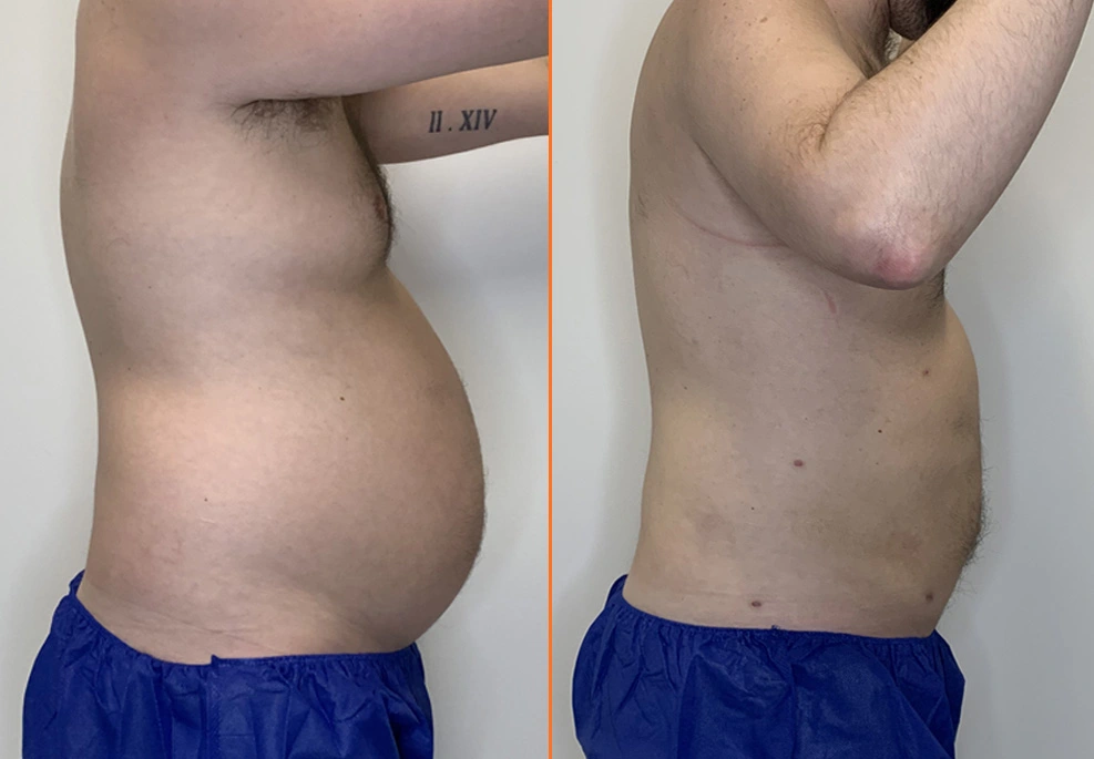 Lipo 360 Case 05