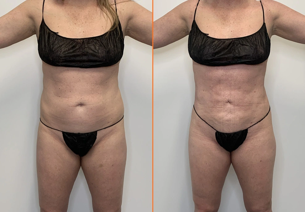 Before and after full frontal torso showing improved abdominal definition and overall body contour