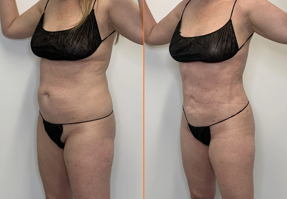 Before and after front torso showing refined midsection and waistline definition