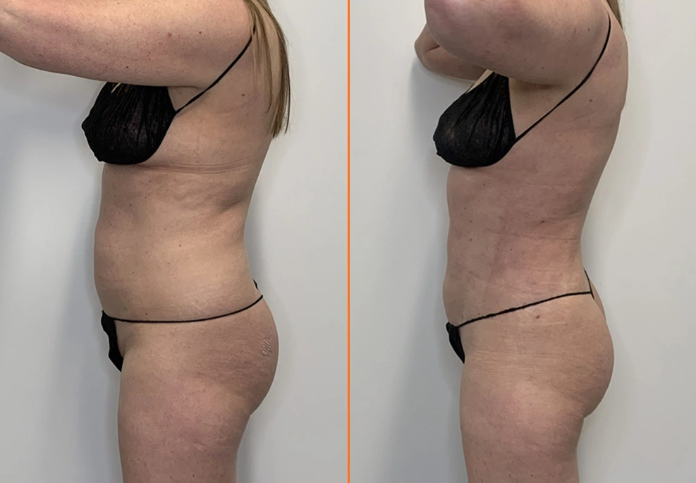 Before and after side profile showing improved abdominal and flank contour