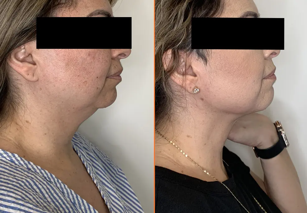 Skin Tightening Treatment Before & After