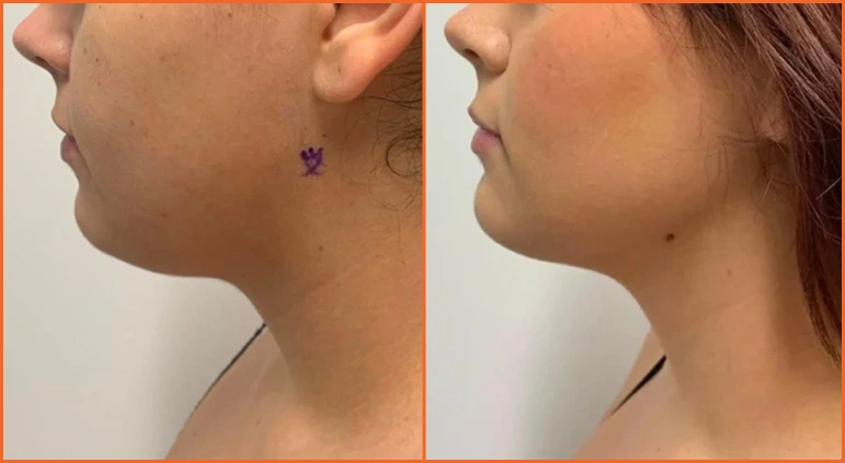 Chin Liposuction Before And After Results Banner