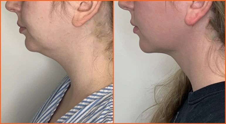 Chin Liposuction Before And After Results Banner