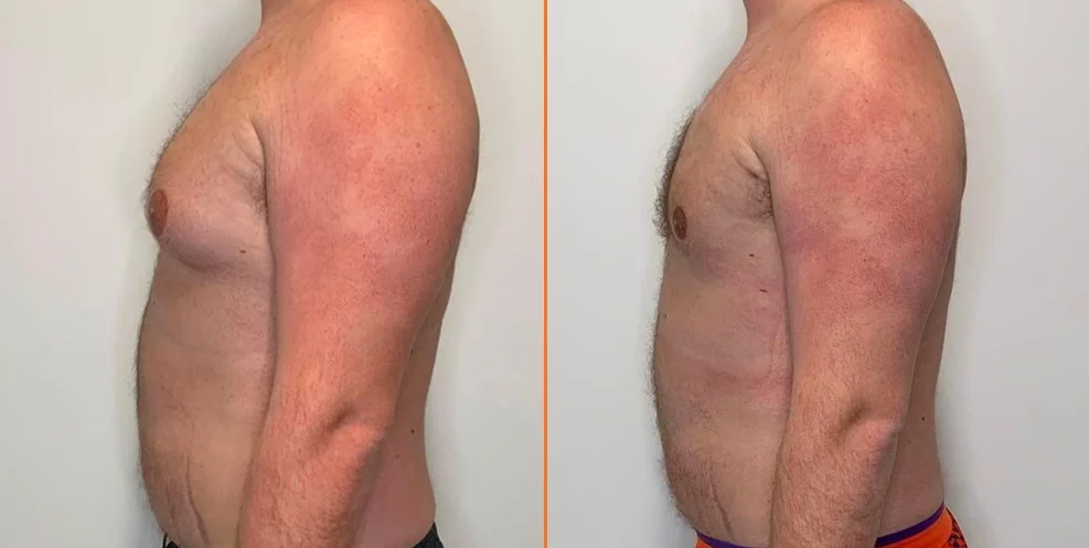 Before and after side views of male torso showing reduced chest tissue