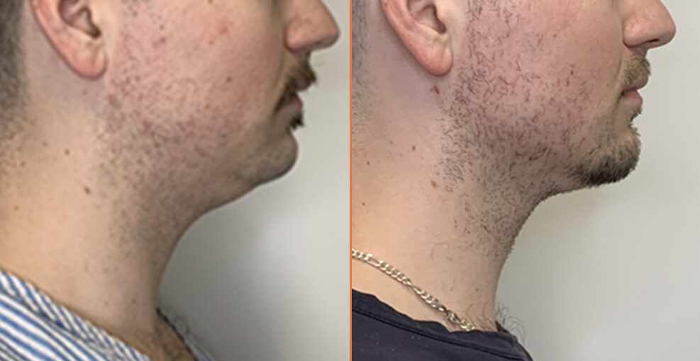 Before and after chin enhancement showing improved chin projection in profile