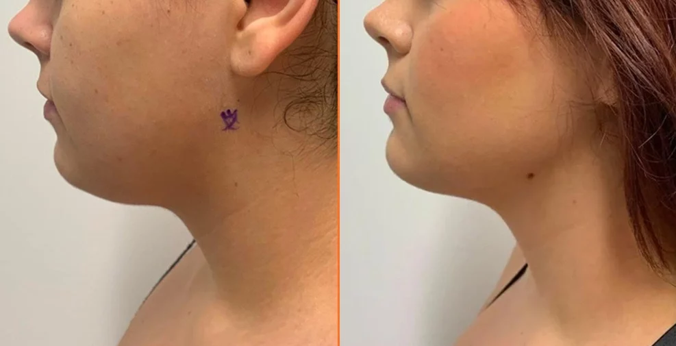 Before and after chin augmentation showing enhanced chin definition in profile