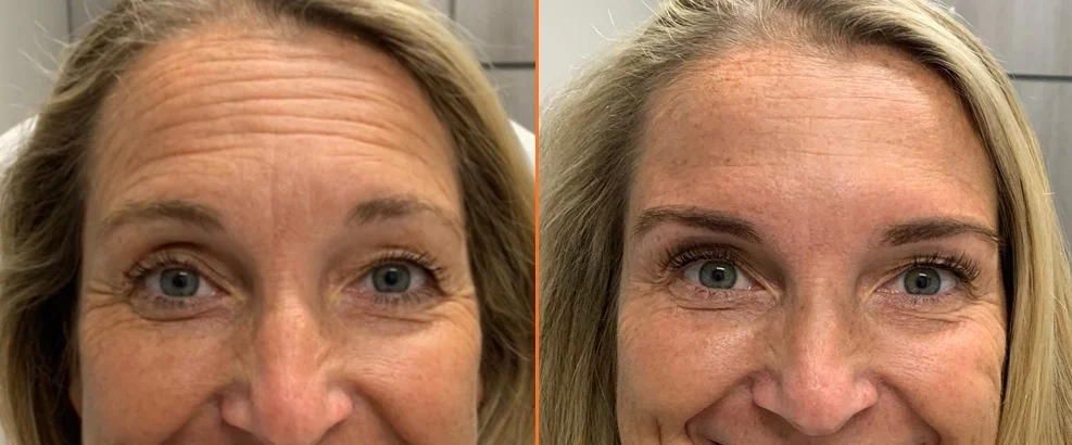 Before and after Dysport treatment showing reduced forehead wrinkles