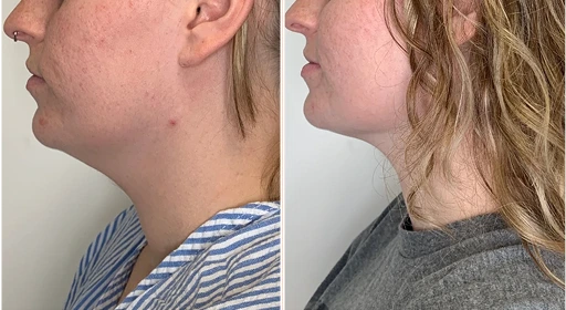 Before and after profile views of chin and neck showing reduced submental fullness