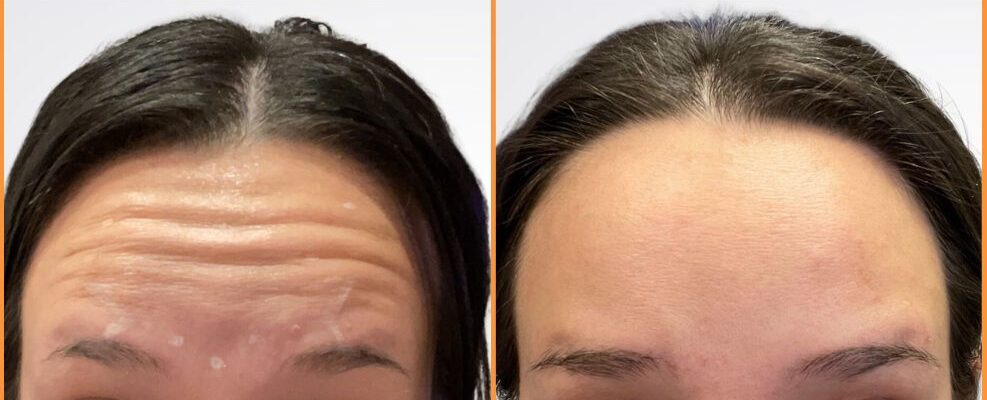 Before and after forehead wrinkle treatment showing smoother skin texture