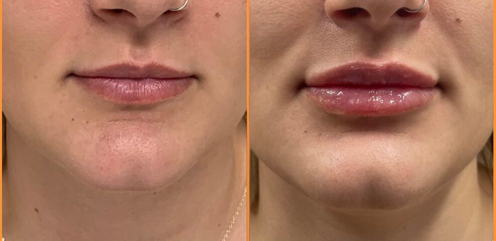 Front view lips before and after filler treatment, showing enhanced volume and lip definition