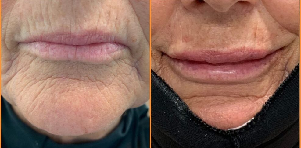 Lower face before and after lip filler, showing improved lip projection and smoothed perioral area