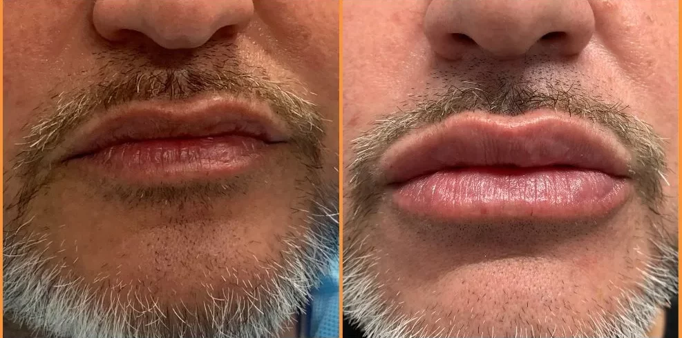 Before and after lip filler results on male patient with enhanced lip volume and shape