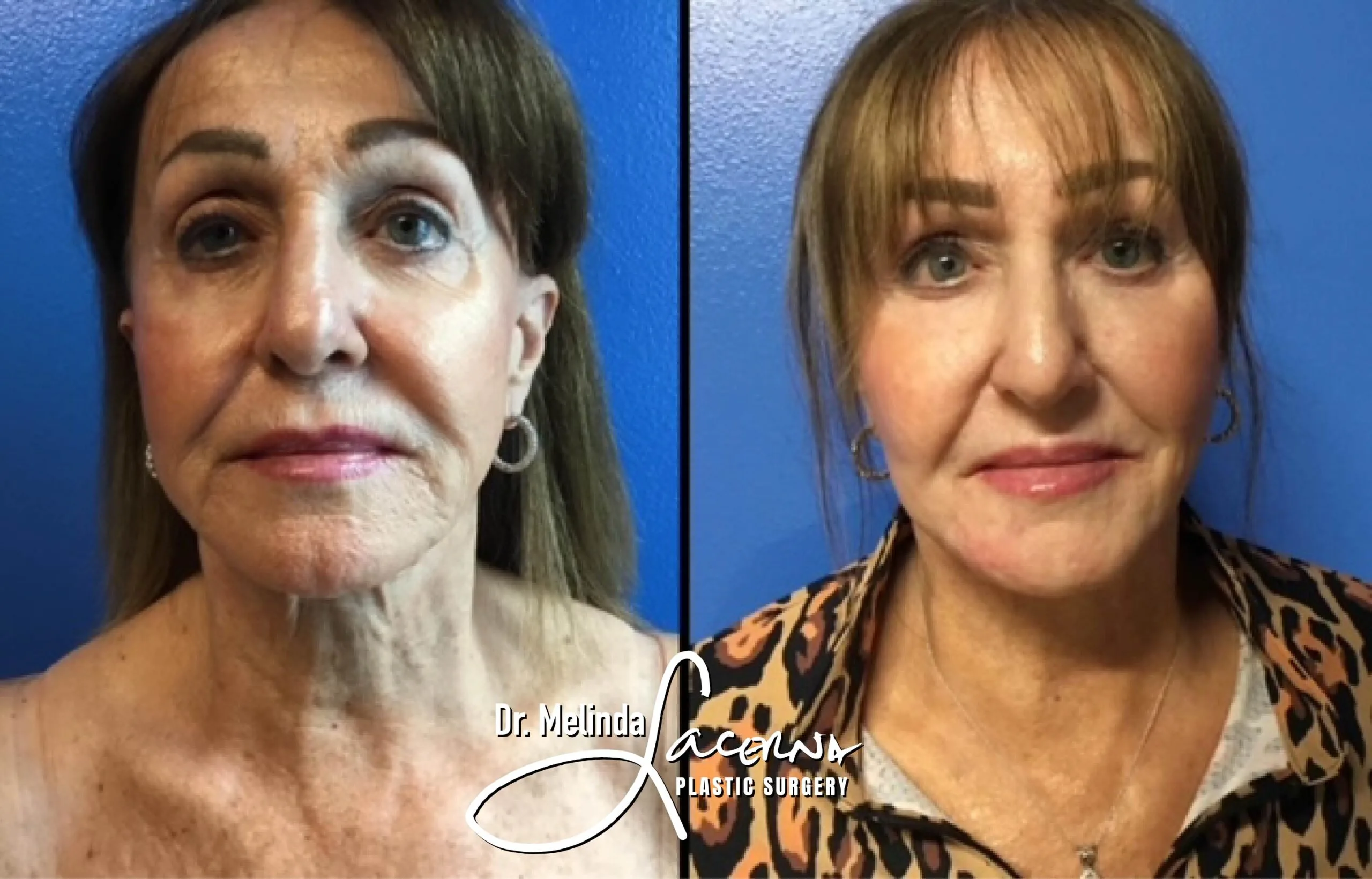 Facelift 10