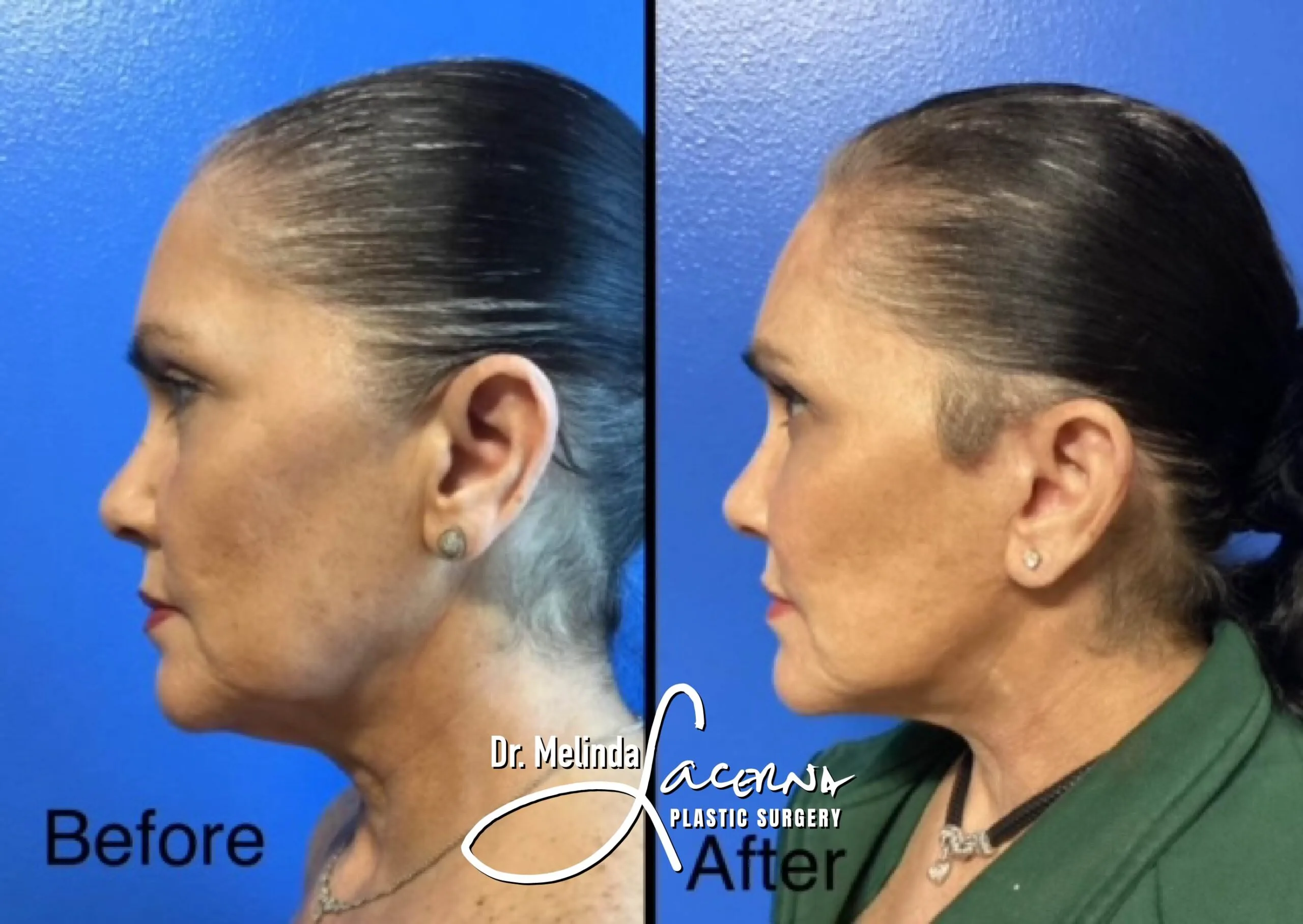 Facelift 11